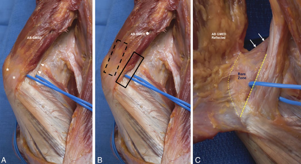 2. Tendon gluteo menor ecografia tempo formacion.jpg